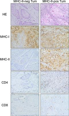 Novel vaccination strategies based on optimal stimulation of CD4+ T helper cells for the treatment of oral squamous cell carcinoma